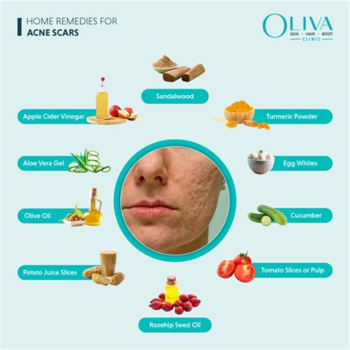 Acne scars forehead - How To Discuss