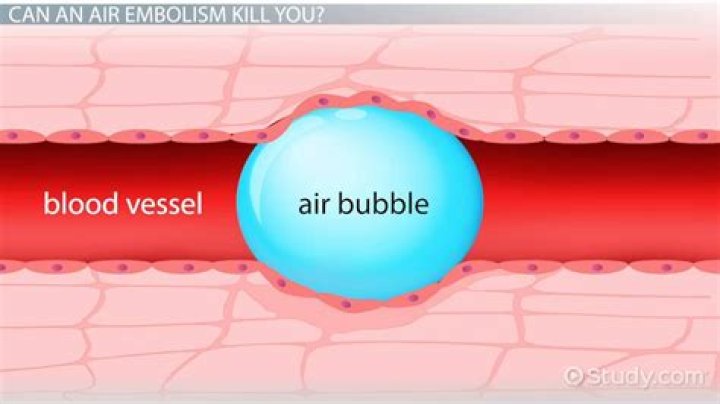 Air Bubble In Iv - How To Discuss