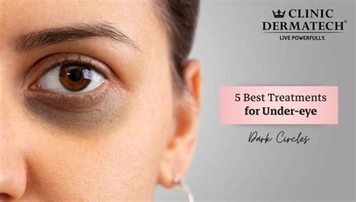 Best treatment for dark circles