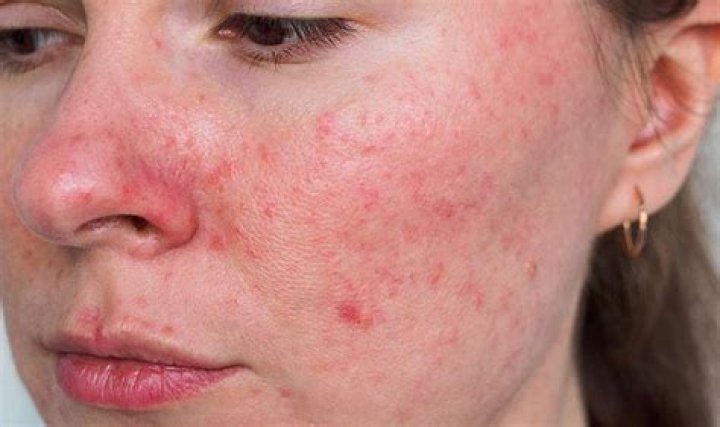 Can rosacea cause acne