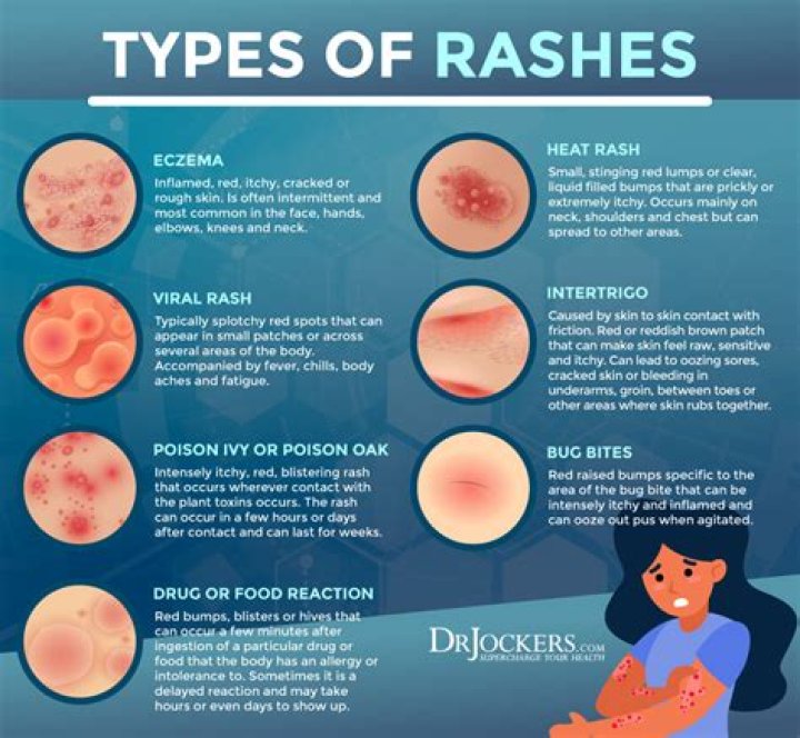 Can SAP cause rashes