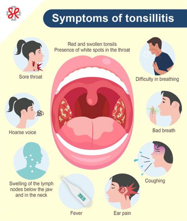Can you catch tonsillitis without tonsils
