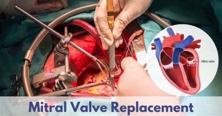 Can you have surgery if you have mitral valve prolapse