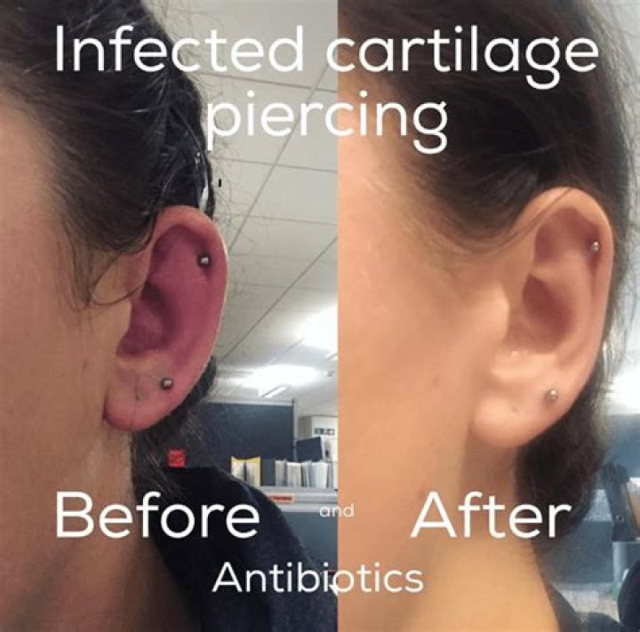 Cartilage Piercing Bleeding After Changing Earring