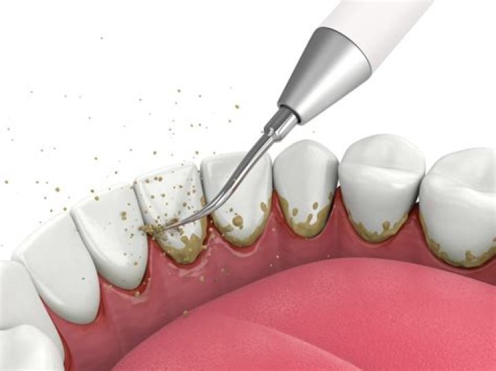 Cavitron Teeth Cleaning - How To Discuss