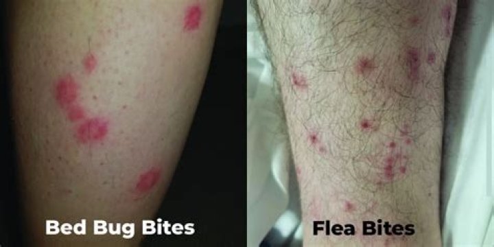 Do bed bug bites have blisters