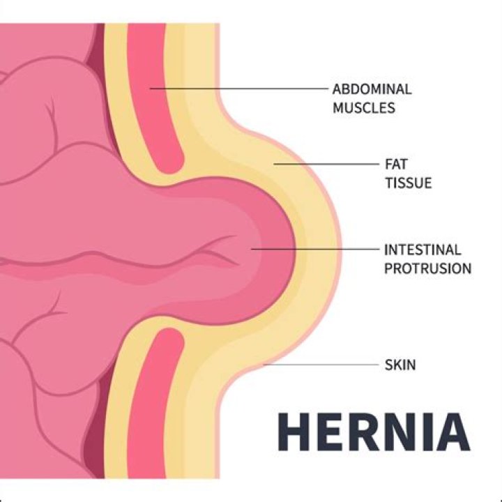 Do hernias Transilluminate