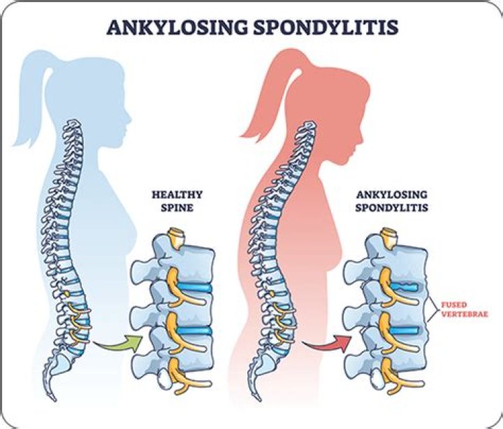Does ankylosing spondylitis affect muscles