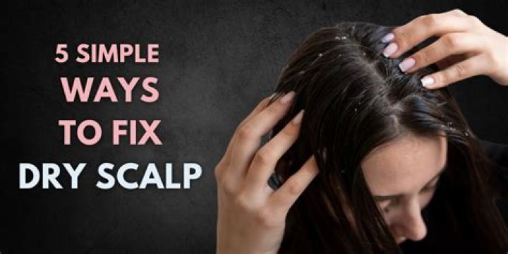 Dry flaky scalp treatment - How To Discuss