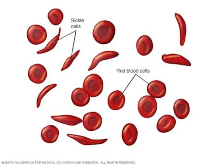 How did sickle cell anemia get its name
