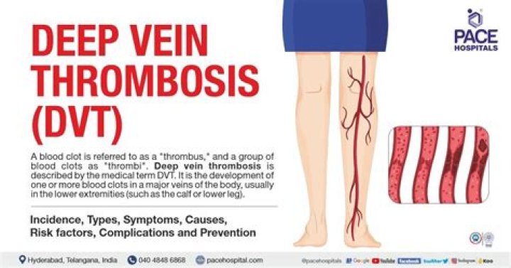 How do you treat ovarian vein thrombosis