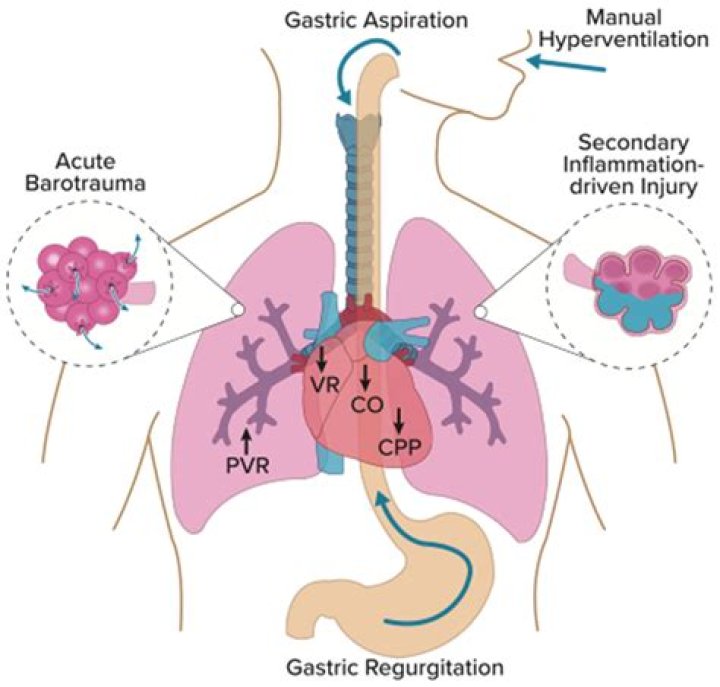How does barotrauma cause a pneumothorax
