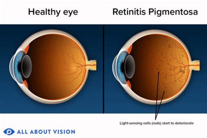 How does retinitis pigmentosa affect vision