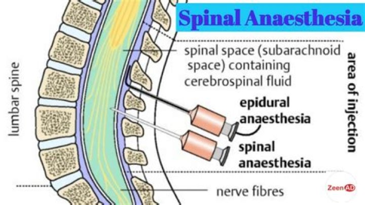 How does spinal anesthesia wear off