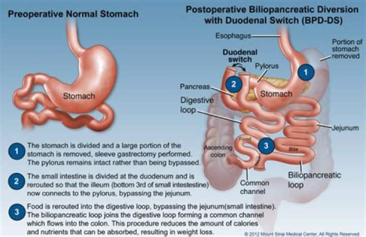 How is a duodenal biopsy performed