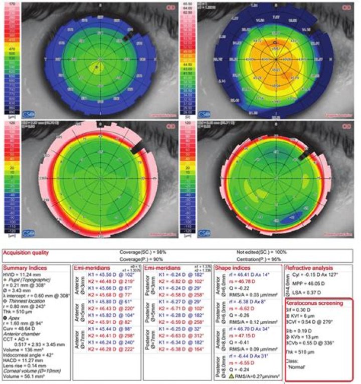 How is corneal topography done