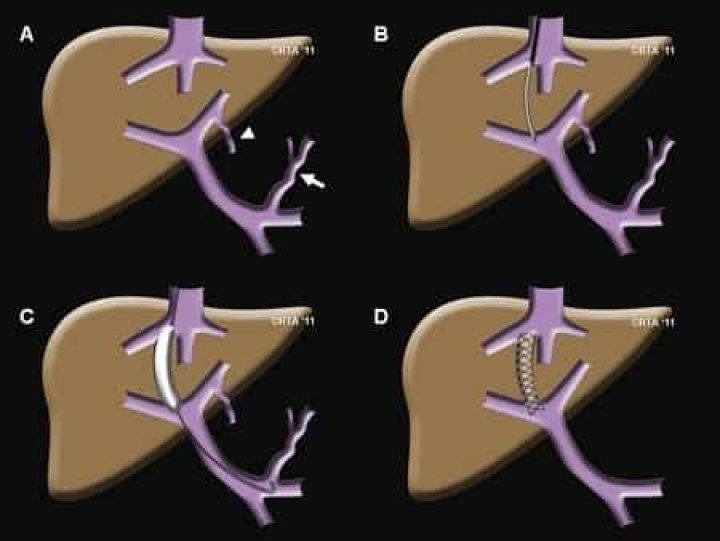 How long can you live after a TIPS procedure