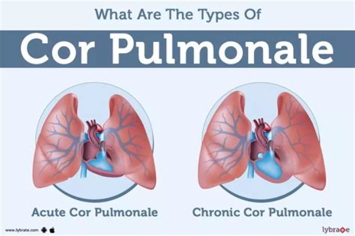 How long can you live with Cor pulmonale