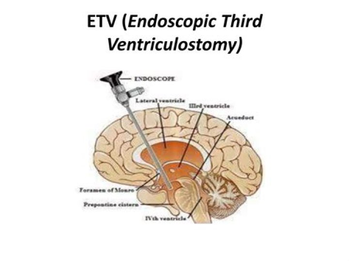 How long does a endoscopic third Ventriculostomy take