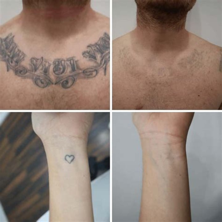 How much does it cost to get a tattoo removed