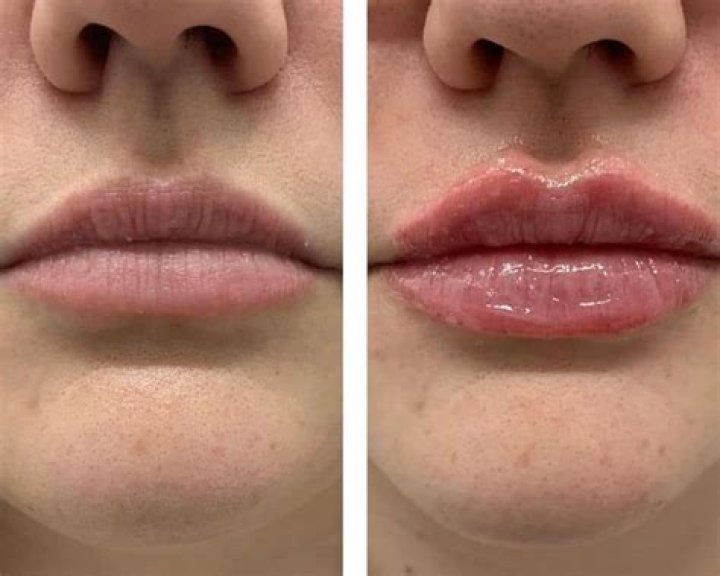 How much is a lip flip
