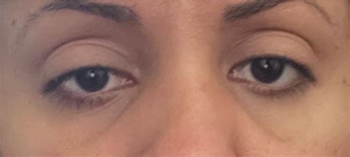 How to get rid of lines under eyes