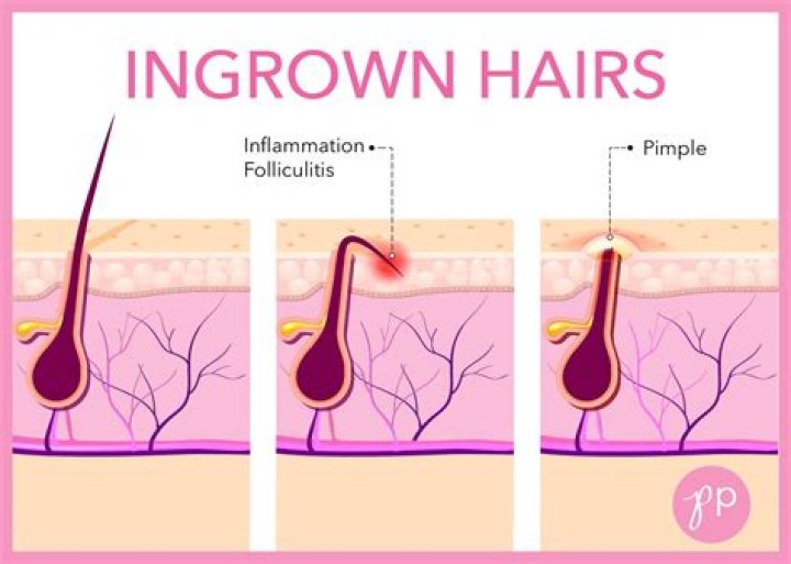 How to stop ingrown hairs