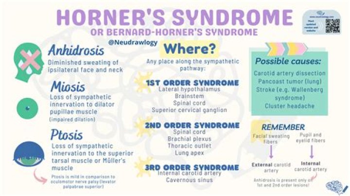 Is Horners syndrome life threatening