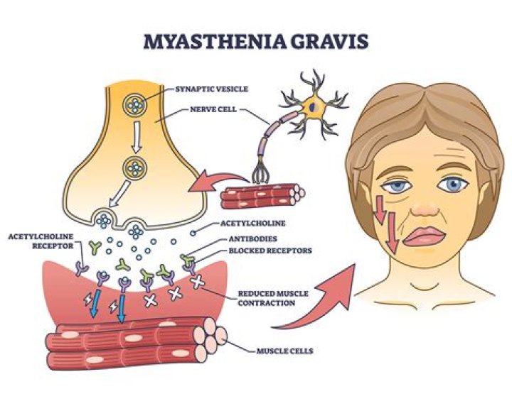 Is myasthenia gravis a muscular dystrophy