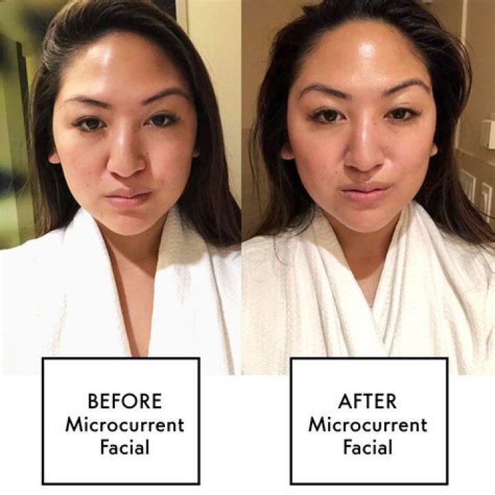 Microcurrent Facial - How To Discuss