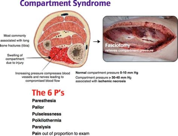 What are the 6 Ps of compartment syndrome