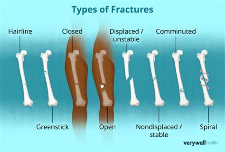What are the most common fractures