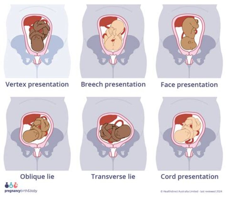 What causes an unstable lie in pregnancy