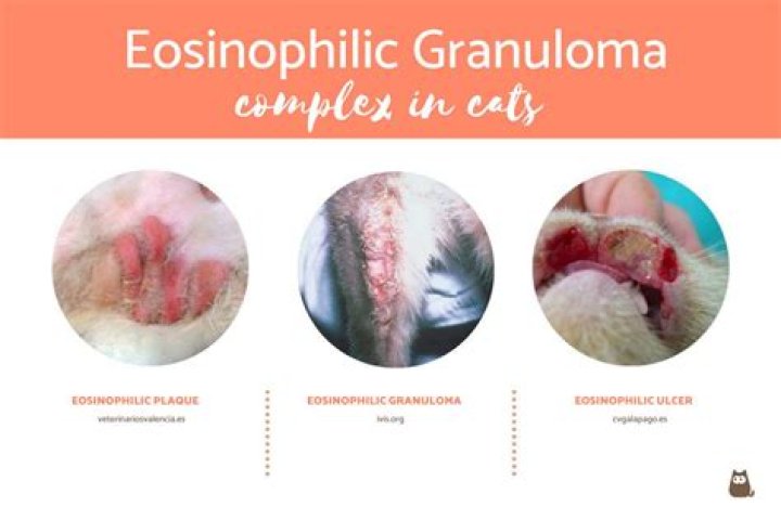 What causes eosinophilic granuloma