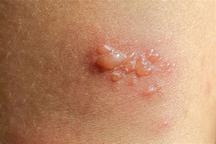 What causes Vesiculitis