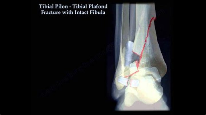 What is a plafond fracture
