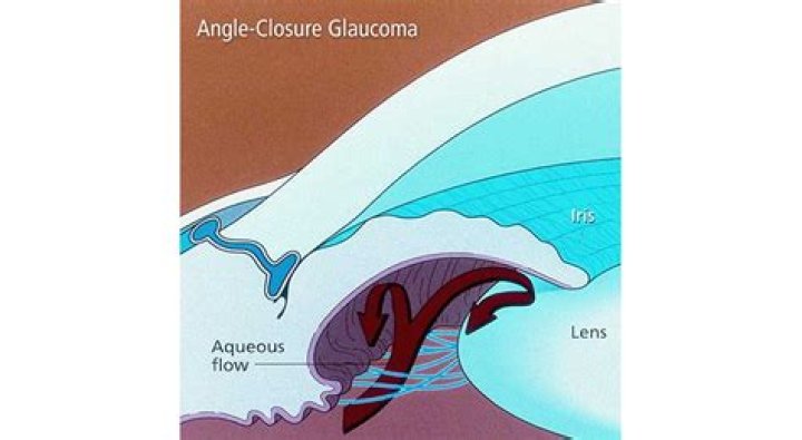 What is acute angle closure