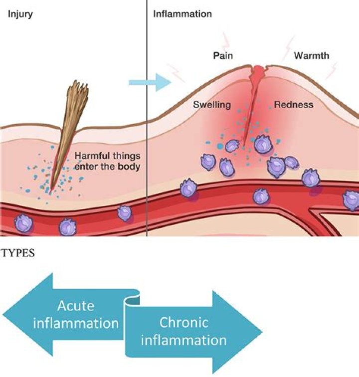 What is cardinal sign of inflammation