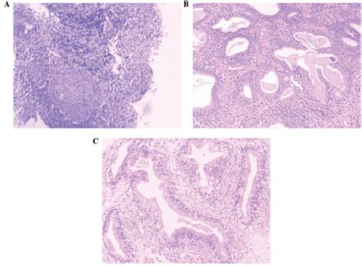What is cystitis Glandularis