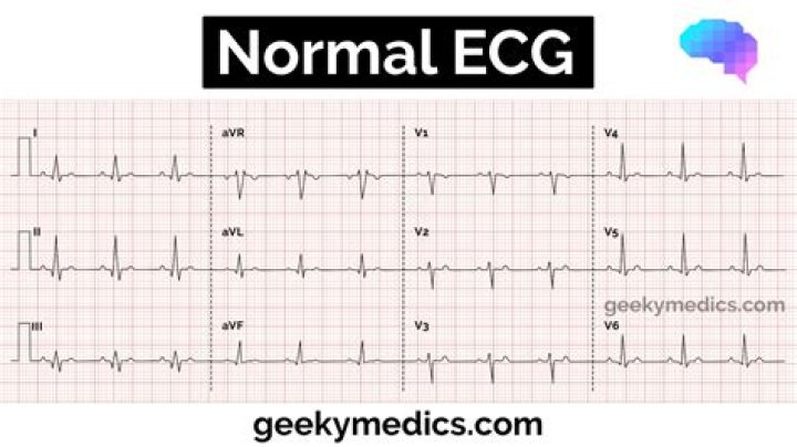 What is normal ECG heart rate