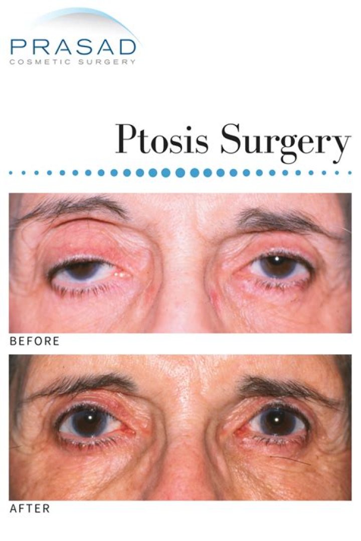 What is ptosis surgery