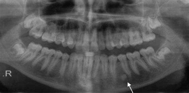 What is radiopacity Dental