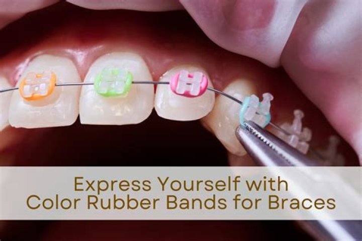 What is the best color rubber bands for braces