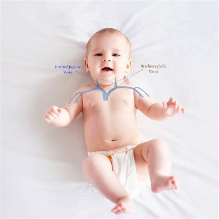 What is the CPT code for brachiocephalic arteriovenous fistula