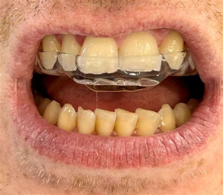 When should I splint my teeth