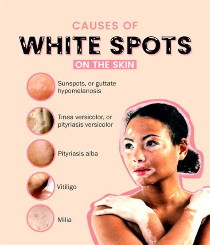 Why do i have white spots on my skin