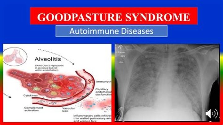 Why is it called Goodpasture syndrome