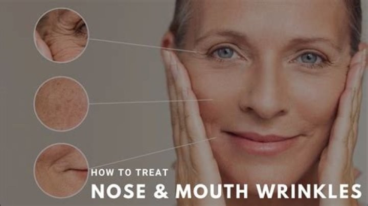 Wrinkles around mouth - How To Discuss